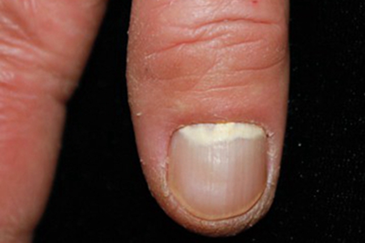 近端甲下型甲真菌病手指甲变色图