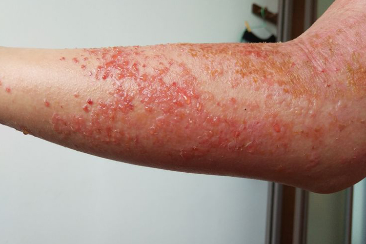 柚子过敏手臂糜烂渗出结痂图