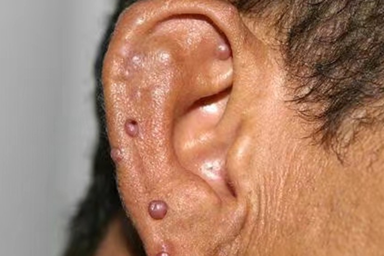 上皮样血管瘤症状图