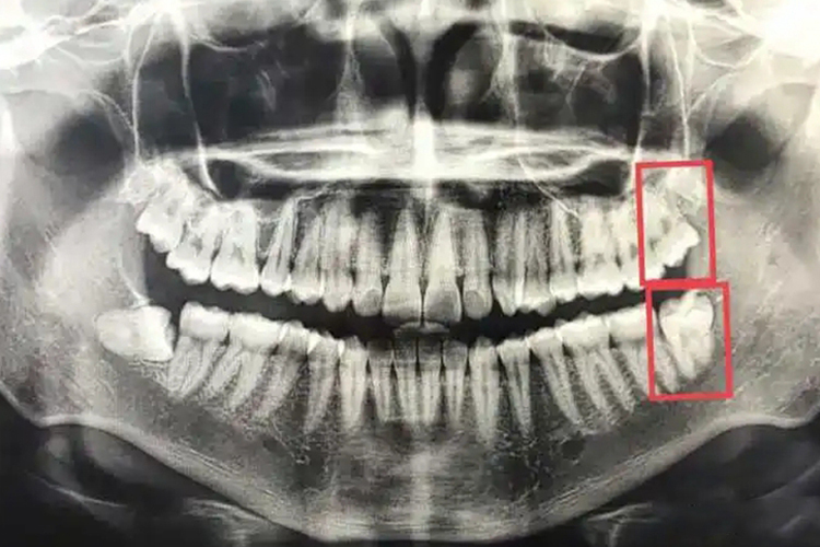 下颌中位阻生智齿图