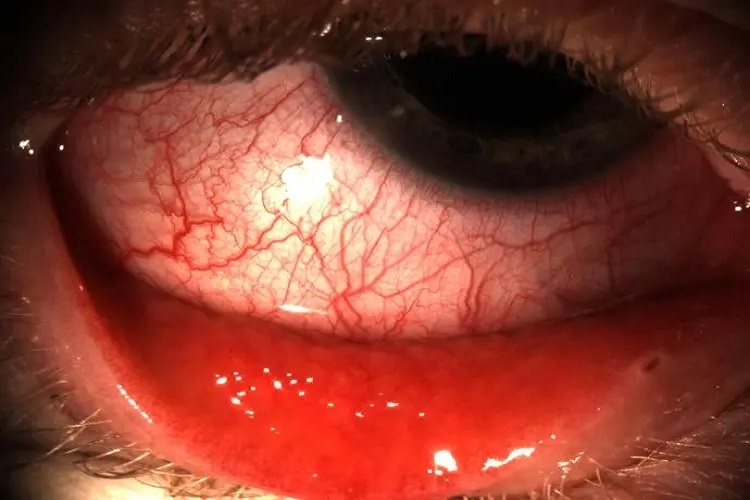 腺病毒性角结膜炎眼部充血图