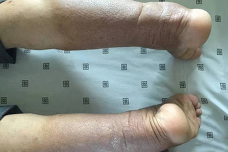 黏液性水肿小腿肿图