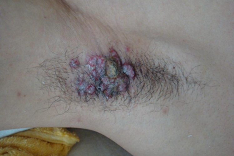 增殖性皮炎疙瘩图 增殖性皮炎疙瘩图