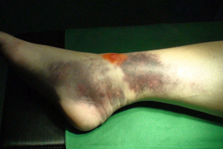 踝关节骨折皮肤发青图 踝关节骨折皮肤发青图