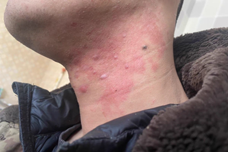 毛囊炎颈部泛红长小疙瘩图