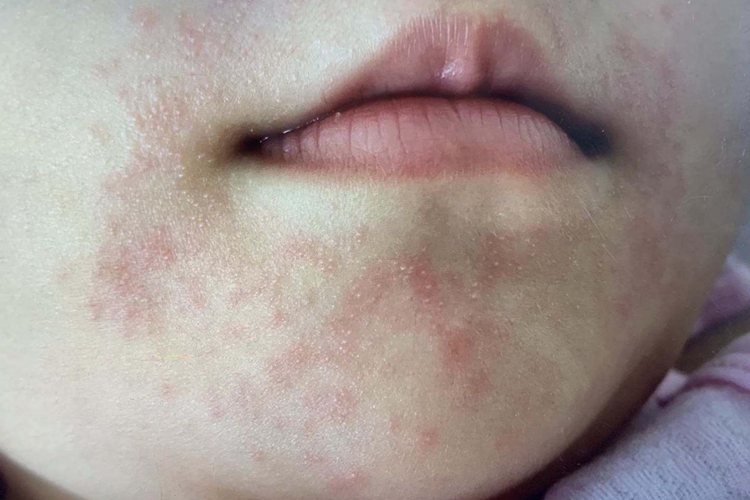 儿童口周皮炎图