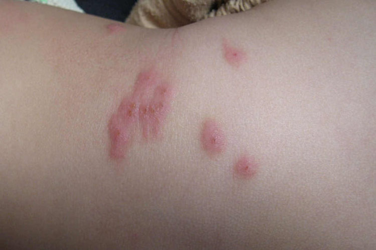 蜱虫子叮咬皮损图