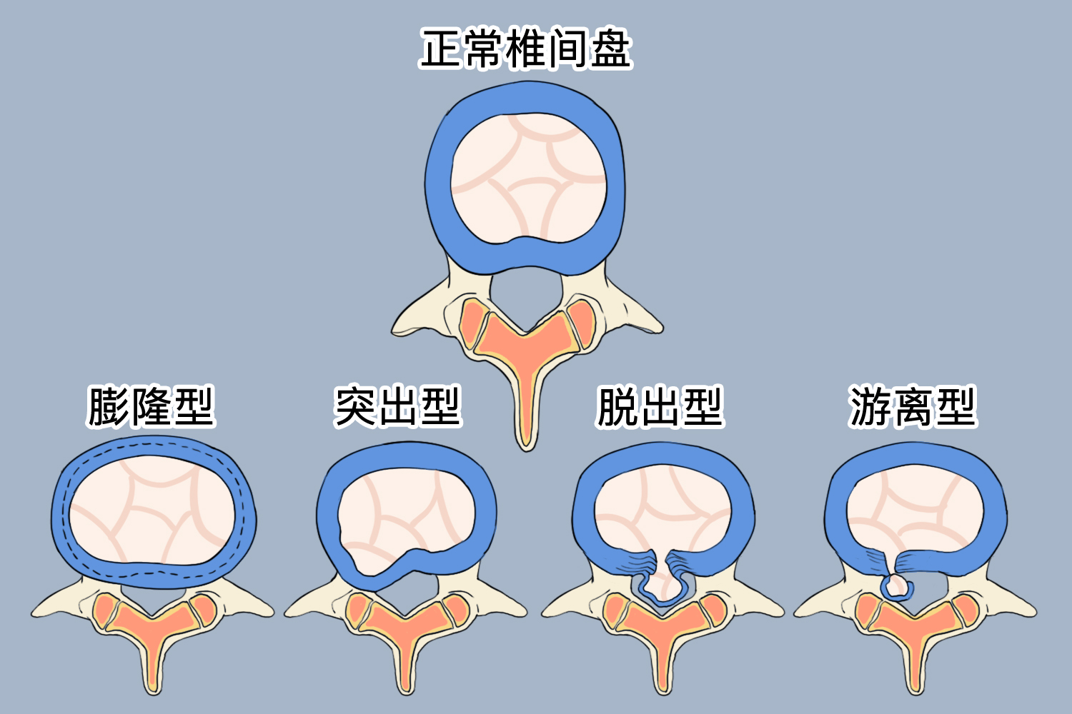 腰椎间盘突出四种类型示意图