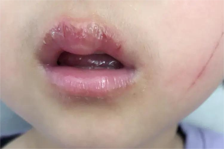 慢性唇炎上嘴唇肿图 慢性唇炎上嘴唇肿图