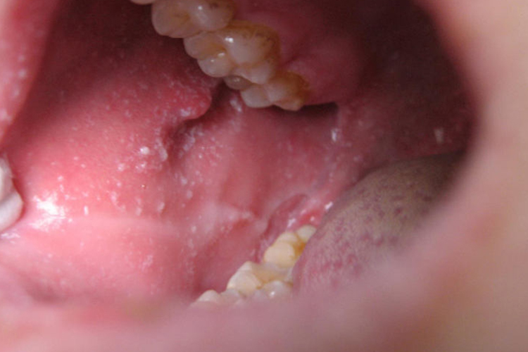 麻疹前驱期科氏斑图