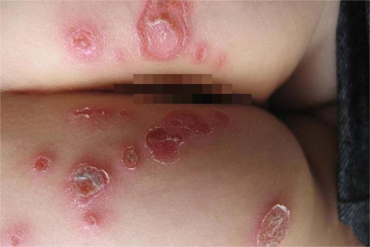 脓疱疮臀部黄痂图