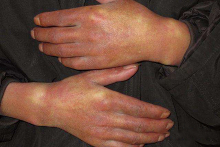 混合性结缔组织病手背皮肤发紫图