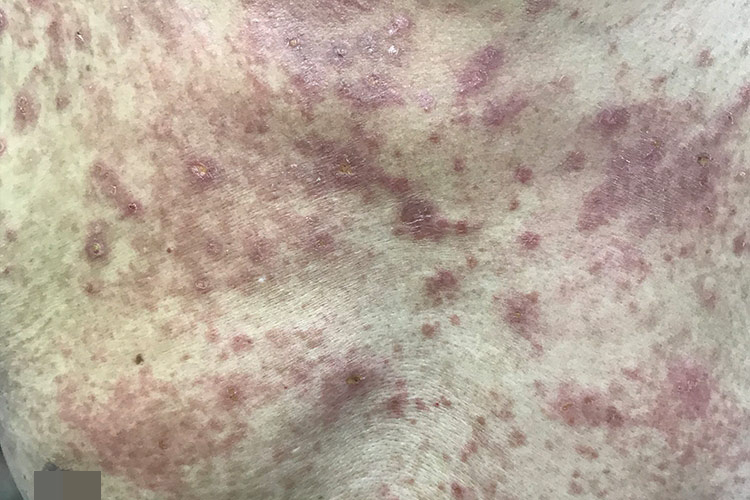 老人亚急性湿疹图