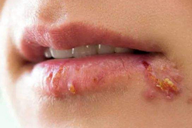 口角炎口周症状图