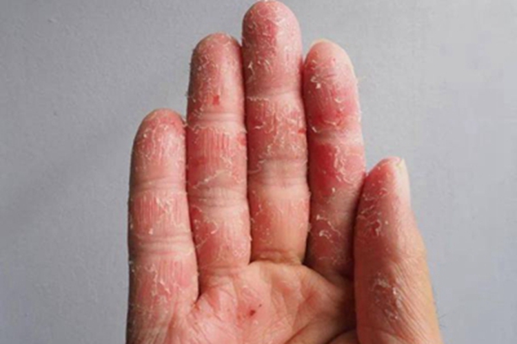 4级手足综合征手部红斑图 4级手足综合征手部红斑图
