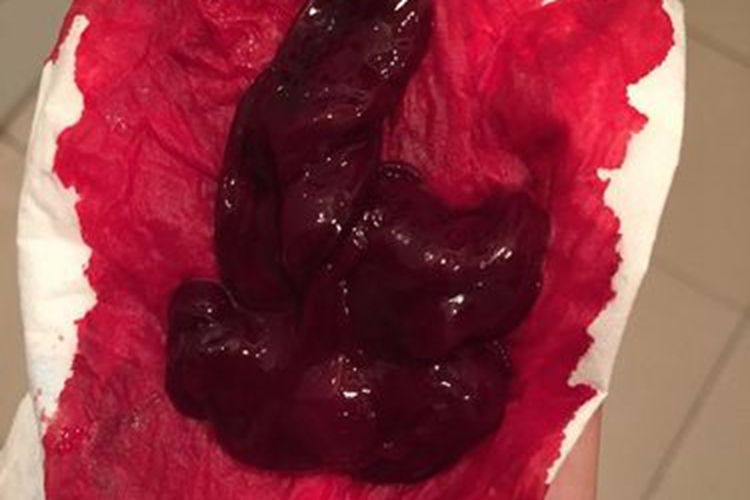 子宫收缩乏力排出黑血块图