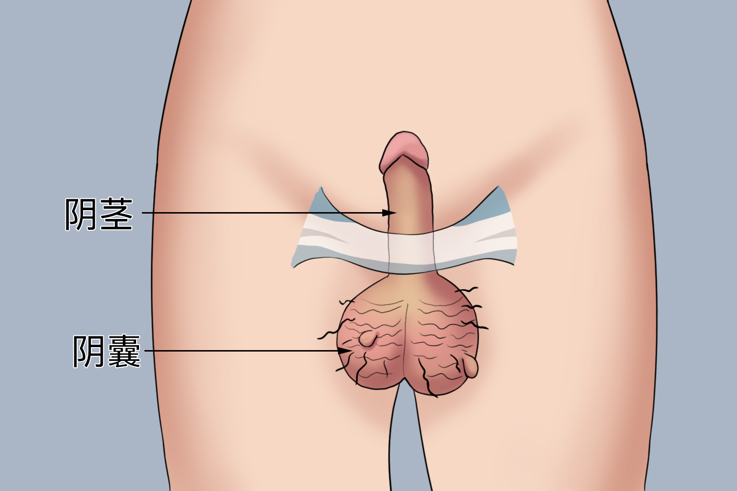 阴囊皮赘图