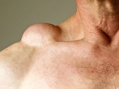 右肩膀脂肪瘤图片图片