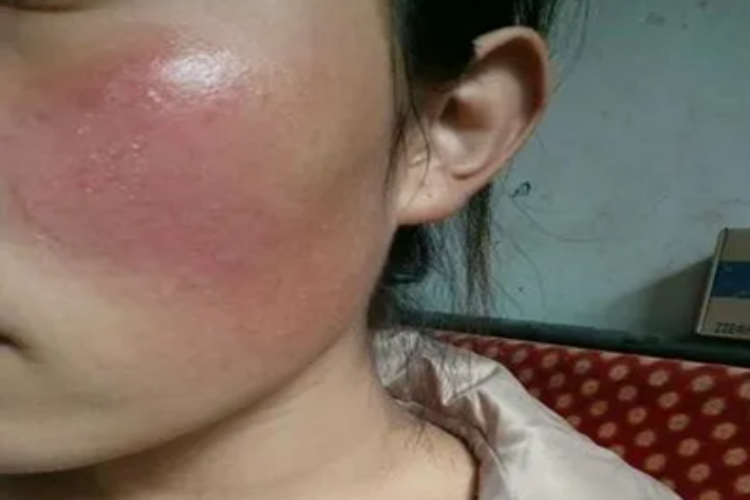 日晒伤脸颊红斑图