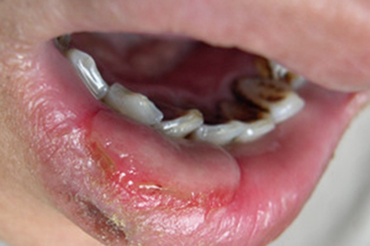 水疱型口腔扁平苔藓症状图