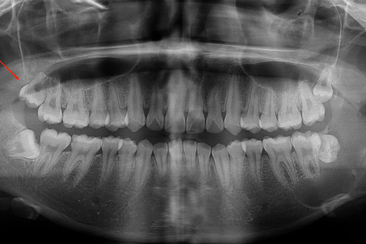 颊向阻生牙影像图 颊向阻生牙影像图