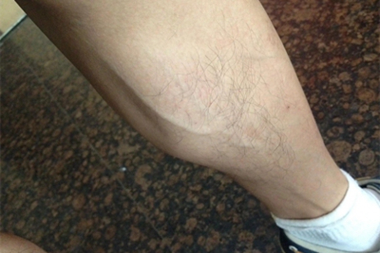 下肢静脉曲张初期症状图 下肢静脉曲张初期症状图