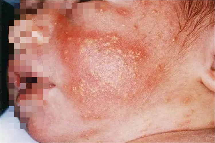 新生儿中毒性红斑图