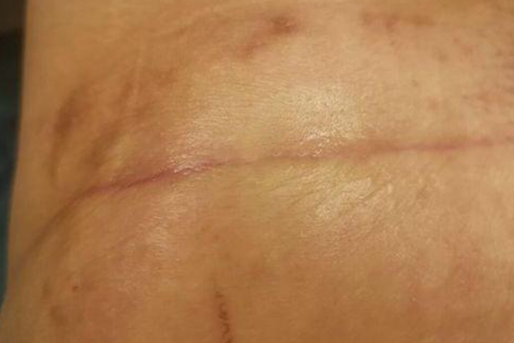 腹壁整形术后三个月疤痕图