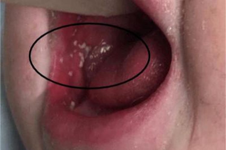 轻型麻疹口腔症状图