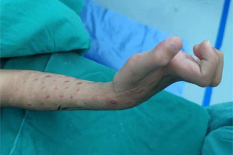 缺血性肌挛缩手部畸形图