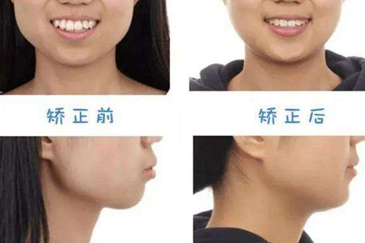 骨性龅牙内收7毫米效果图