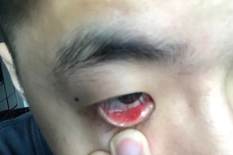 霰粒肿翻开眼皮结膜充血图