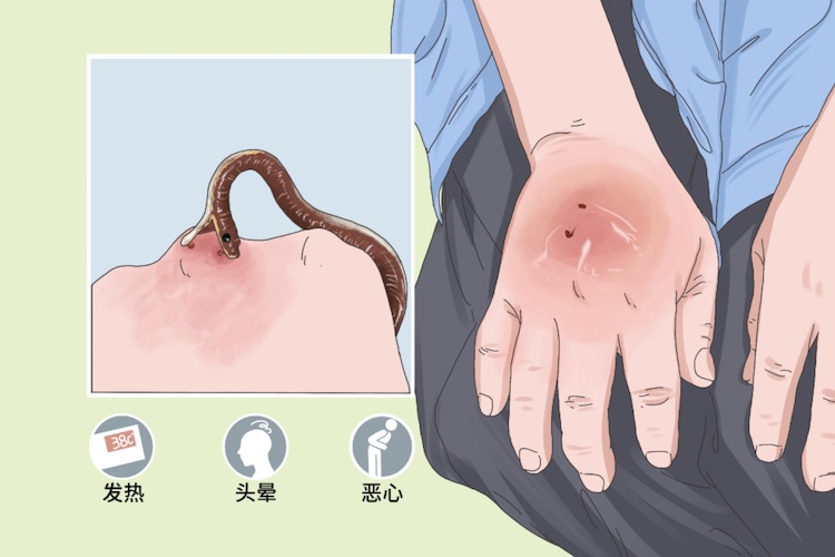 有毒蛇咬伤图