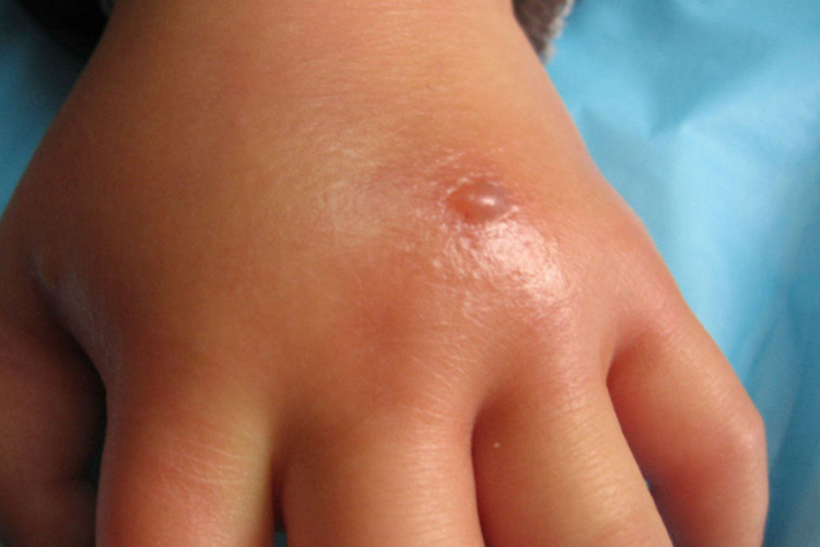 蠓叮咬手背症状图 蠓叮咬手背症状图