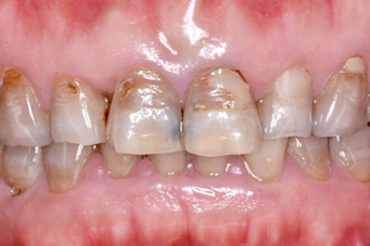 重度四环素牙缺损图