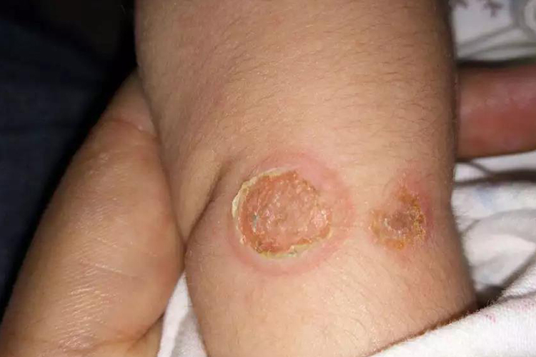 蚊虫叮咬后感染图