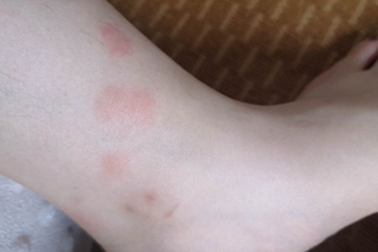 跳蚤叮咬小腿斑图