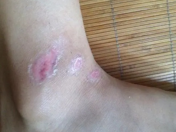 烫伤掉痂后红印子恢复图 烫伤掉痂后红印子恢复图