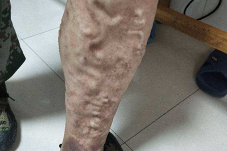 下肢静脉曲张症状图 下肢静脉曲张症状图