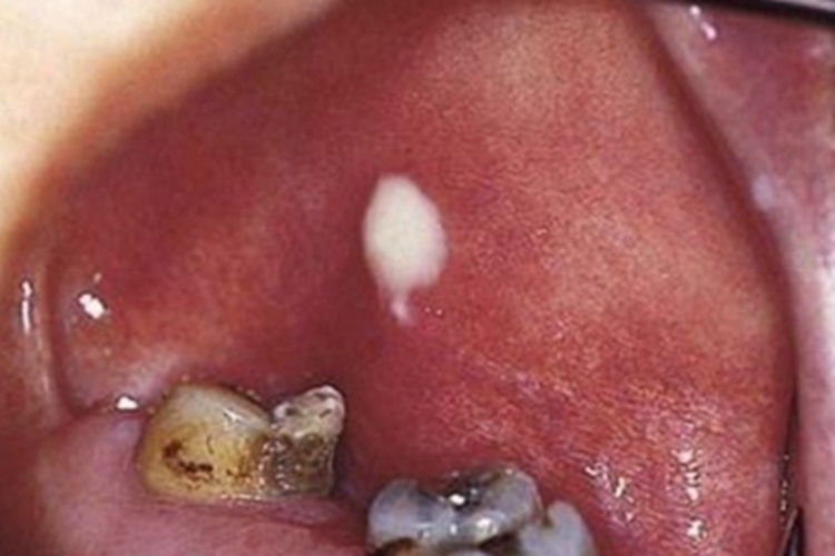 急性化脓性腮腺炎口腔症状图 急性化脓性腮腺炎口腔症状图