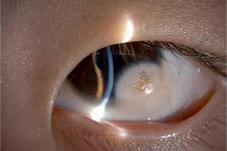 角膜皮样瘤眼球白斑图