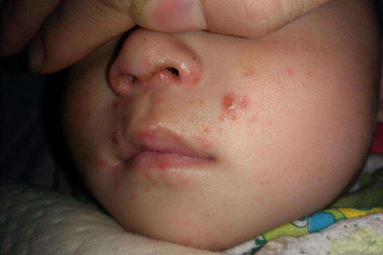 十个月宝宝起水痘图