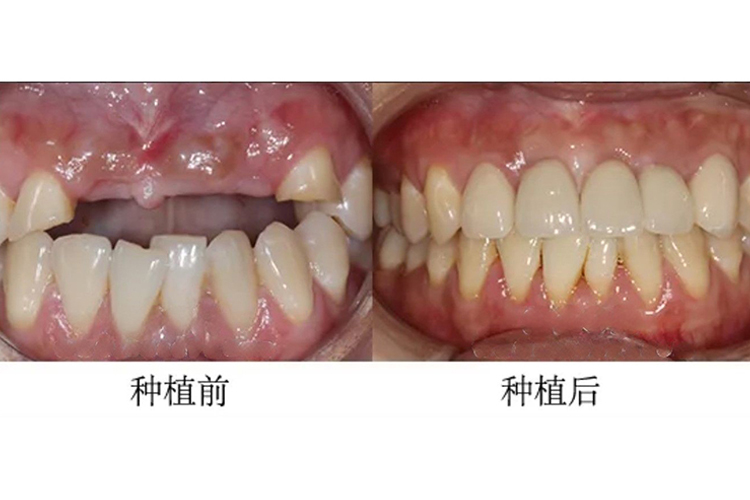 多颗上牙种植牙效果图 多颗上牙种植牙效果图