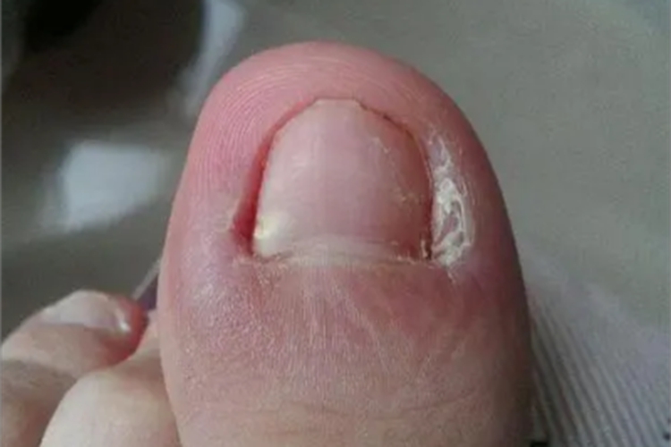 慢性甲沟炎大拇脚趾甲变形图 慢性甲沟炎大拇脚趾甲变形图
