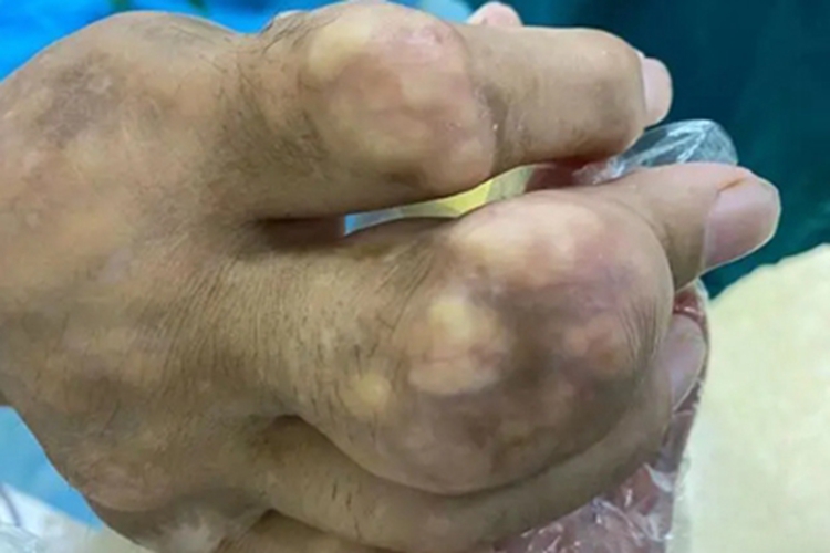 痛风手指上有黄白色硬块图