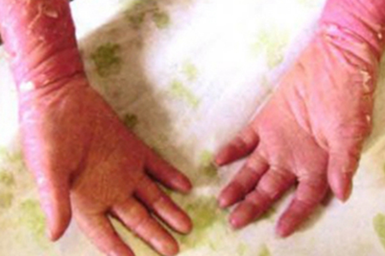 鱼鳞病手部脱皮图