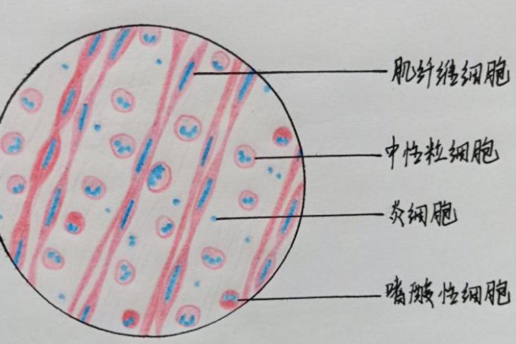 蜂窝织炎性阑尾炎红蓝铅笔手绘图