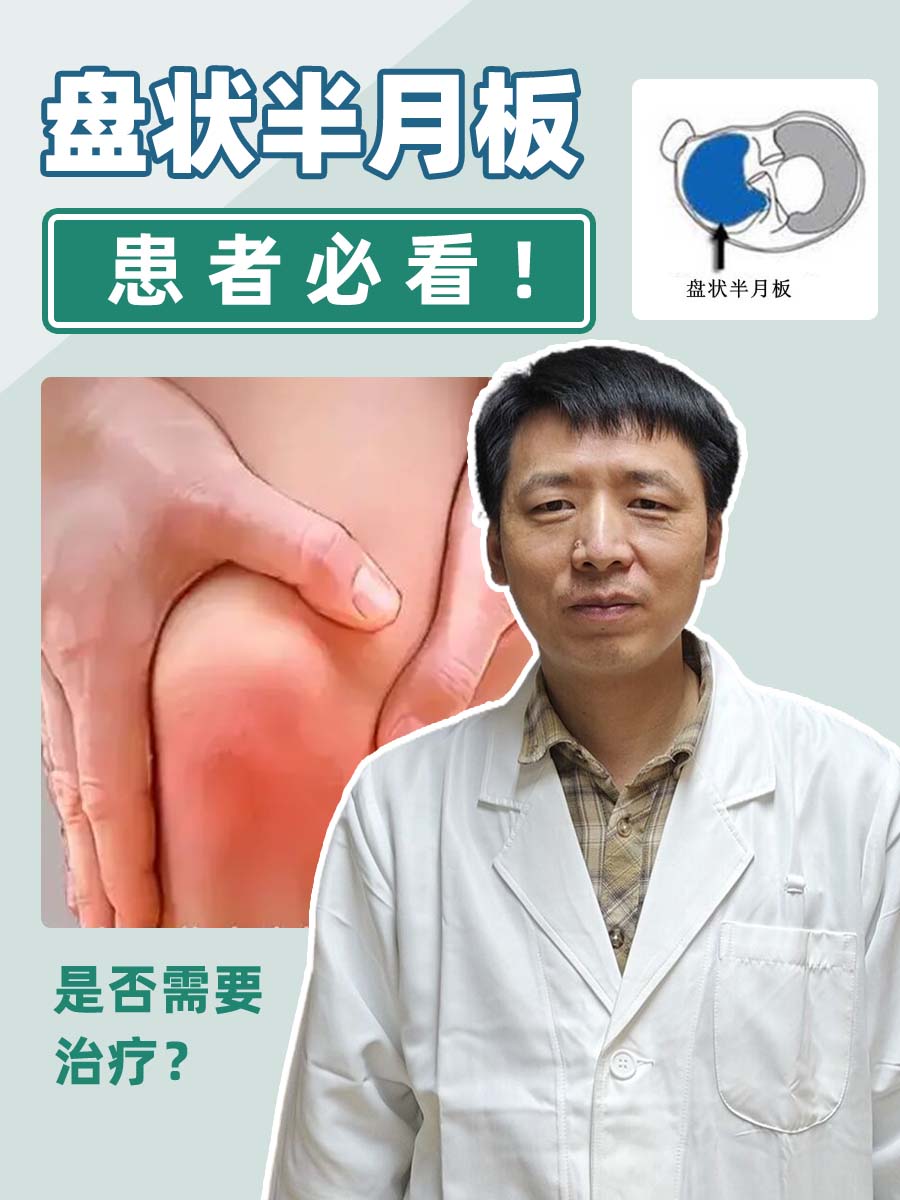 盘状半月板患者必看！是否需要治疗？