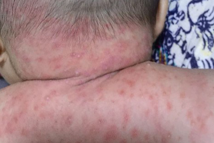 宝宝脖子毛囊炎图 宝宝脖子毛囊炎图