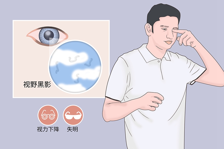 近视眼飞蚊症视物图 近视眼飞蚊症视物图